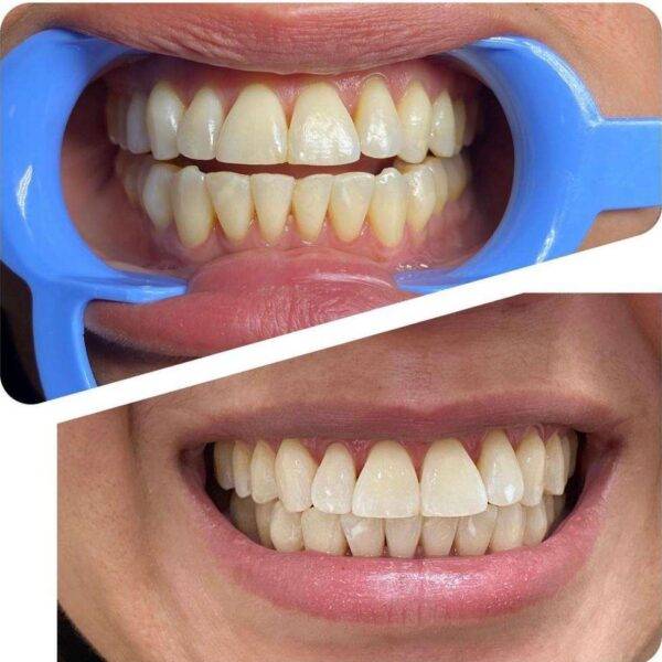 Teeth whitening 1024x974 1